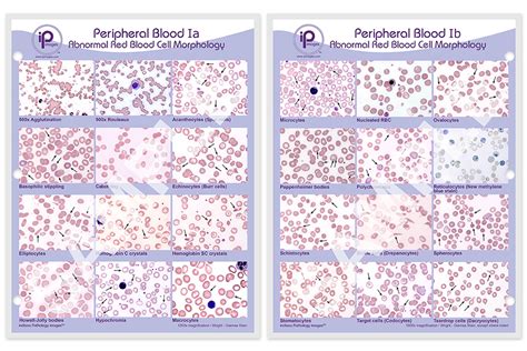rbc morphology abnormal results|rbc morphology grading chart.